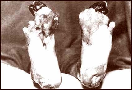 more trench foot