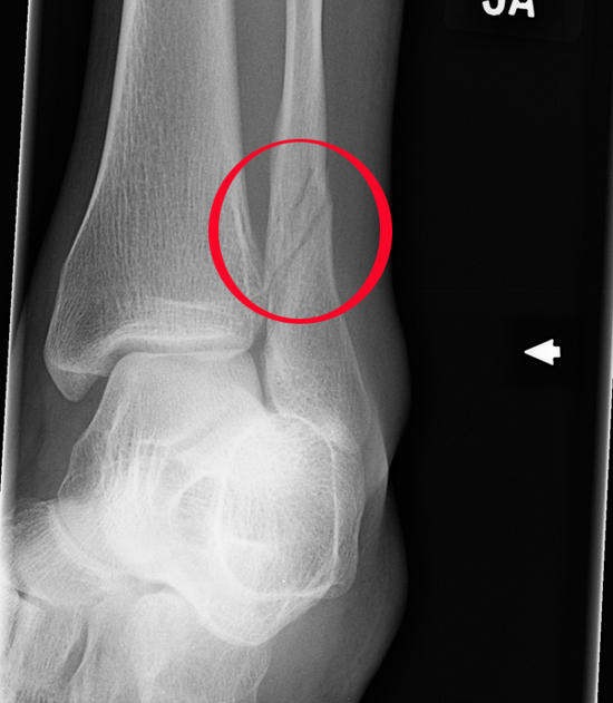 my busted leg