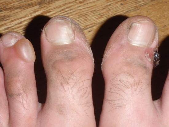 My toes...