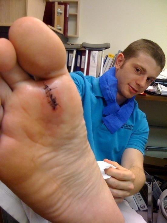 nail in foot