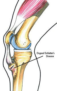 Osgood-Schlatter Disease