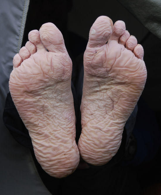 trench_foot