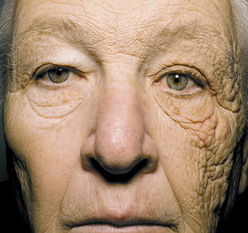 Old trucker sun damage