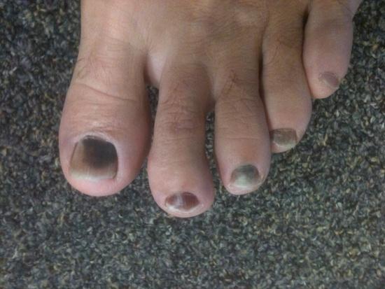 Dead toe nails