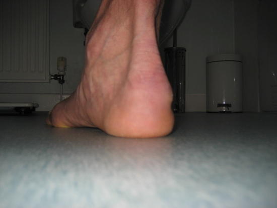 Heel spur