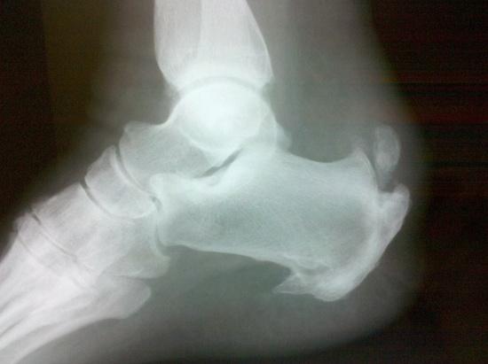 Heel