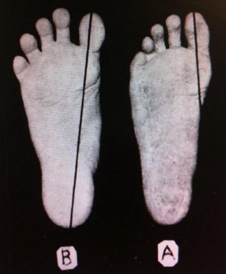 foot comparison