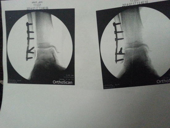 ankle